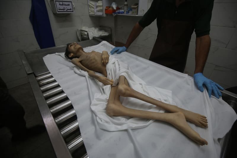 Malnatry children number in Gaza Tria by March